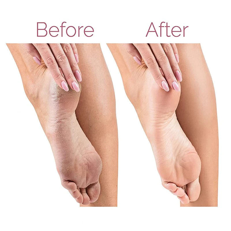 Electric Callus Remover – Rechargeable Foot File & Pedicure Tool for Smooth Feet